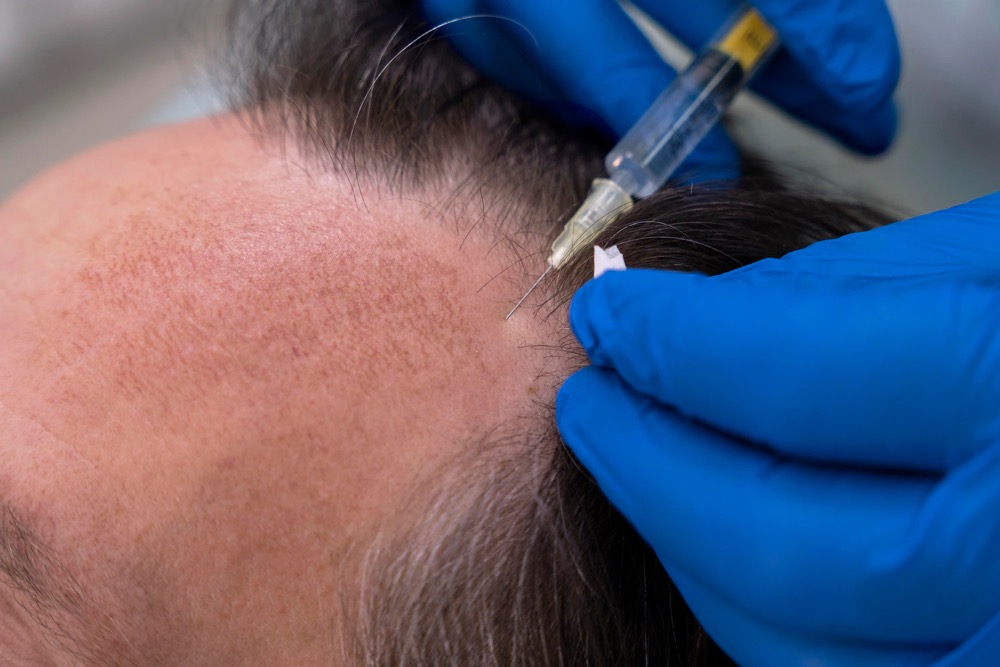 Mesoterapia capilar para mujer